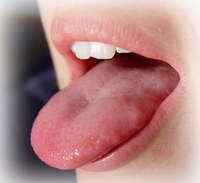 Dangers of Tongue Piercing