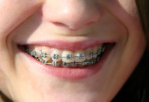 braces-doon-south-dental-kitchener